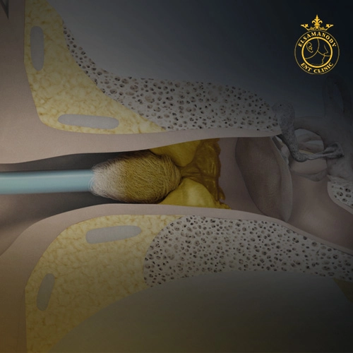 إزالة شمع الأذن 