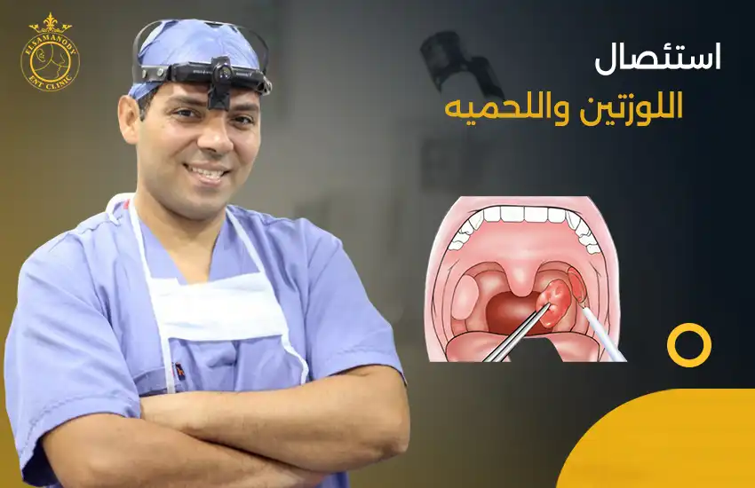 عملية استئصال اللوزتين عند الكبار
